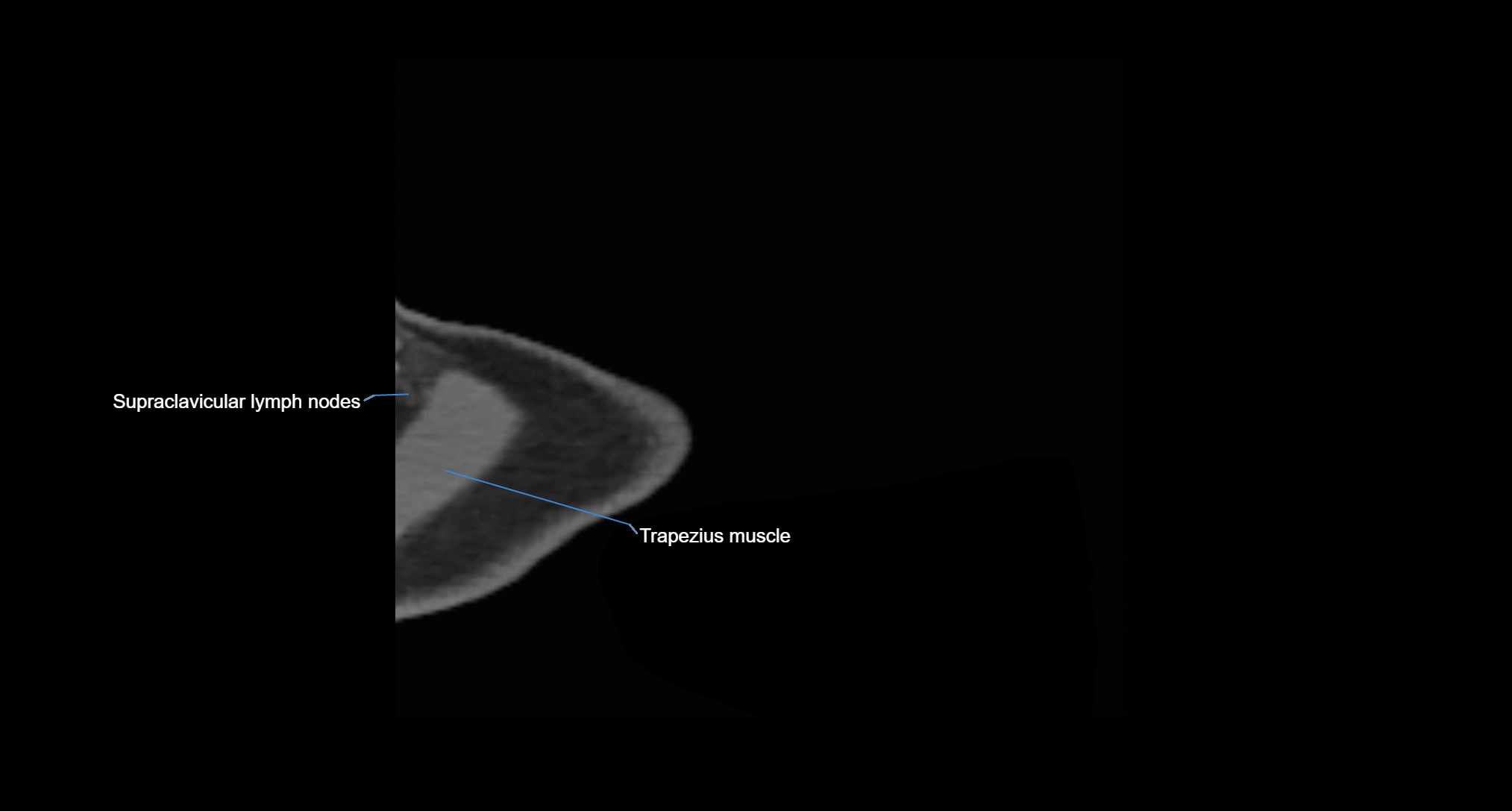 CT Shoulder axial cross sectional anatomy labelled radiology image -00001.webp